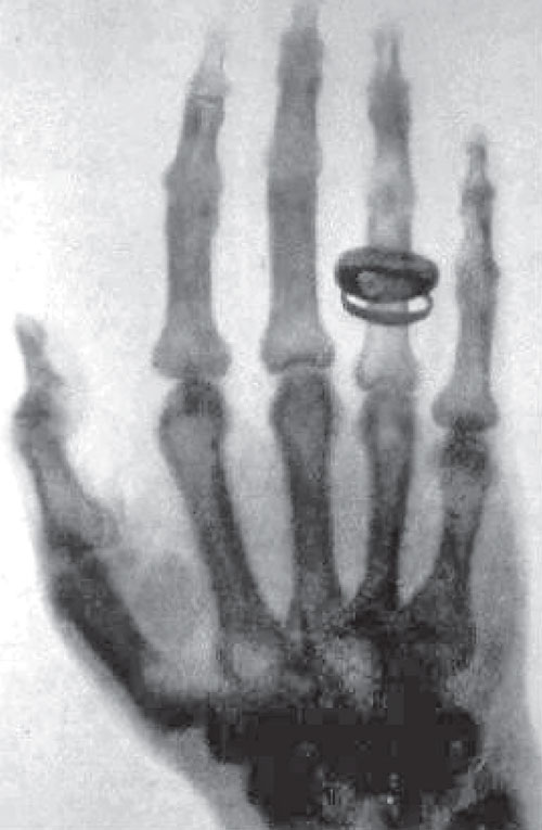 Anna Bertha's Hand X-ray