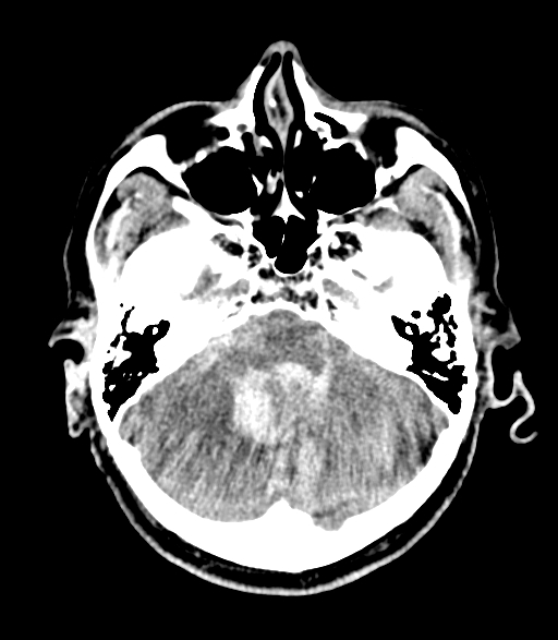 致密颅底导致的射束硬化伪影