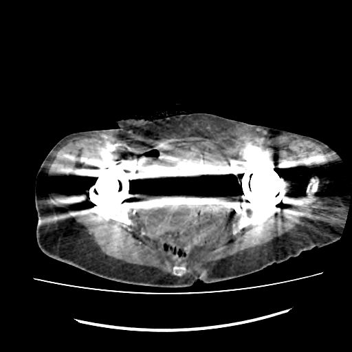 左右髋关节假体