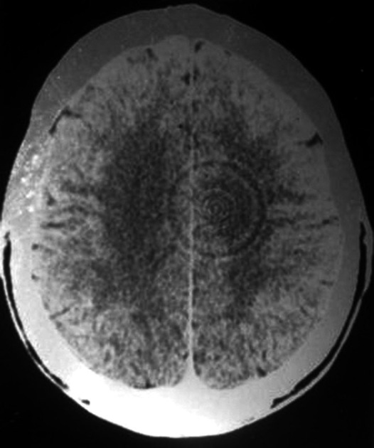 脑部扫描的环形伪影