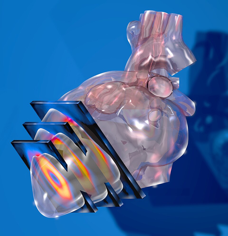 SPECT心肌灌注成像