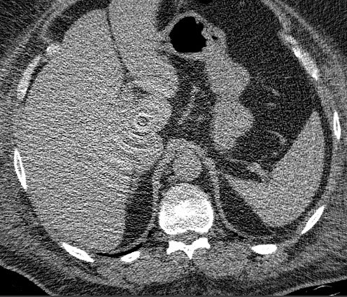 CT环形伪影示例